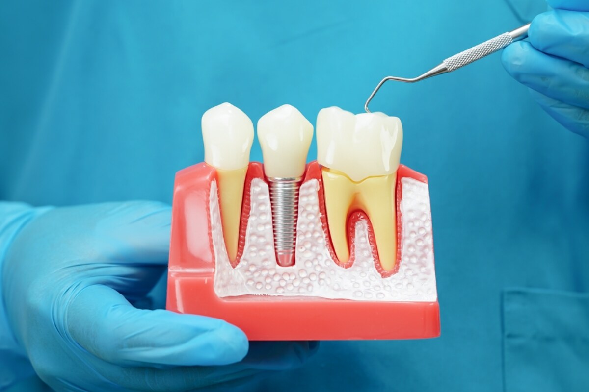 caring for your dental crown tips for long lasting results
