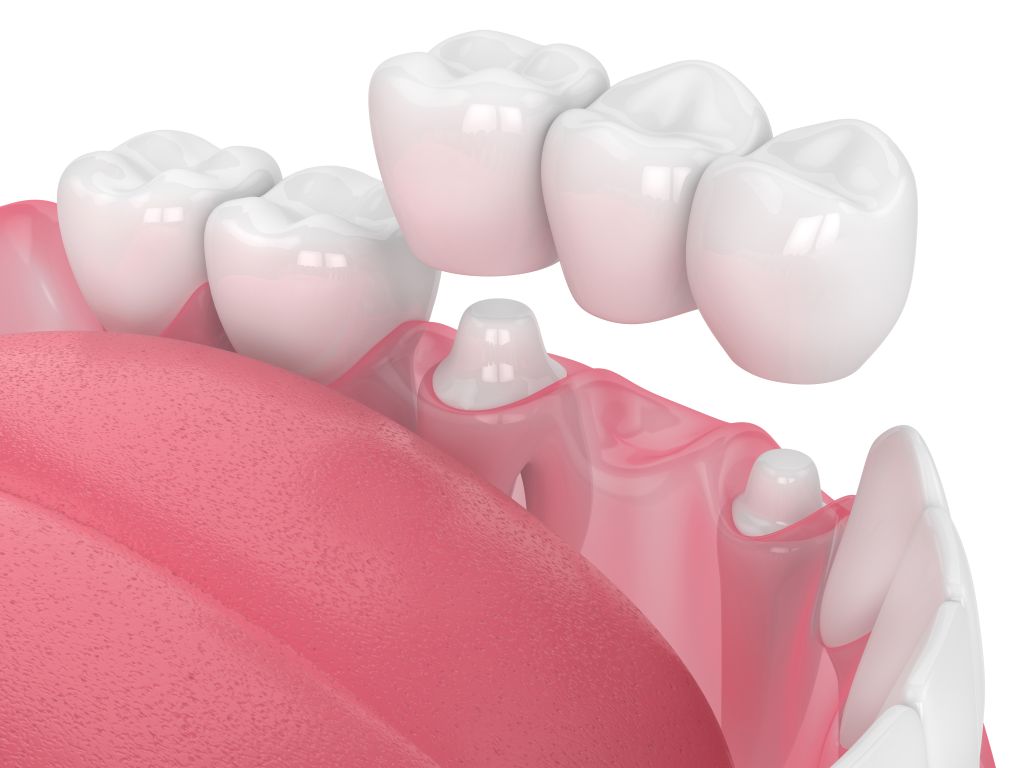 dental bridges in airdrie