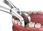 tooth extraction