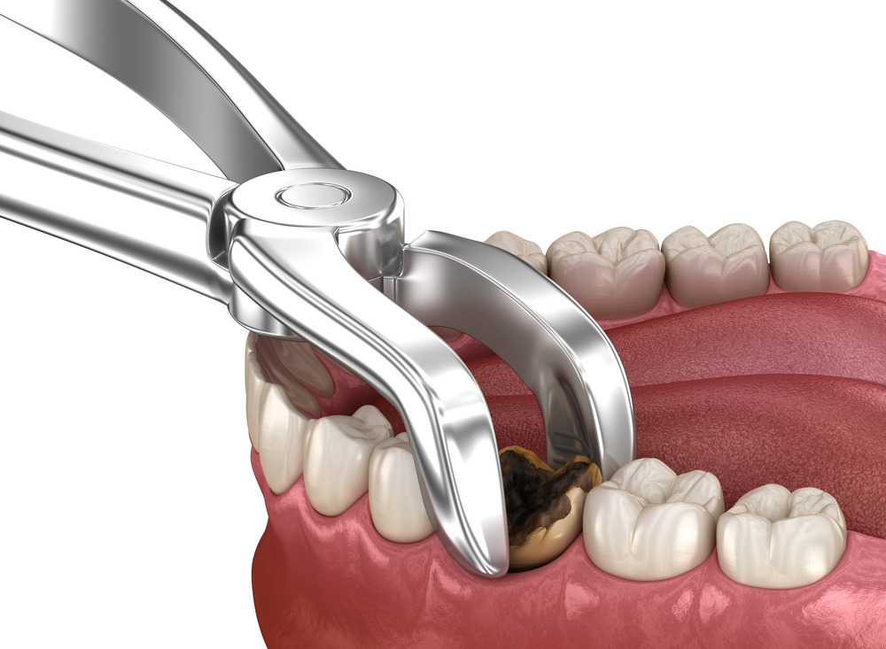 tooth extraction