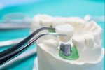 dental crowns in airdrie, ab
